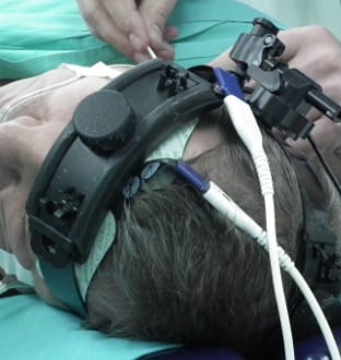 Echipamente pentru monitorizarea creierului și a fluxului sanguin în timpul endarterectomiei carotidiene microchirurgicale