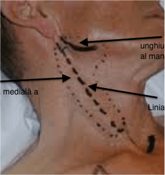 Schiță a inciziei pielii pentru endarterectomie carotidiană, cu mai multe variante de poziționare