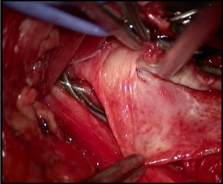 Bifurcația carotidiană după endarterectomie microchirurgicală, cu perete arterial neted și lumen fiziologic