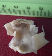 Placă aterosclerotică carotidiană îndepărtată în bloc prin endarterectomie
