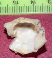 Detaliu al plăcii carotidiene îndepărtate prin tehnică microchirurgicală