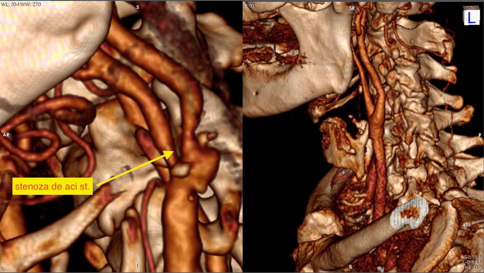 CT-angio carotidian înainte și după endarterectomie microchirurgicală