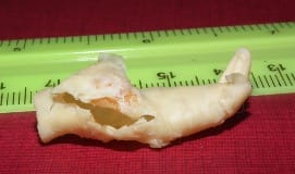Fragmente de placă ateromatoasă îndepărtate din artera carotidă