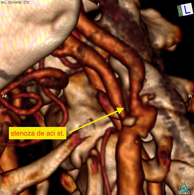 Dr. Bodiu Adrian neurochirurg- Stenoză artera carotidă, imagine 3D detaliată.