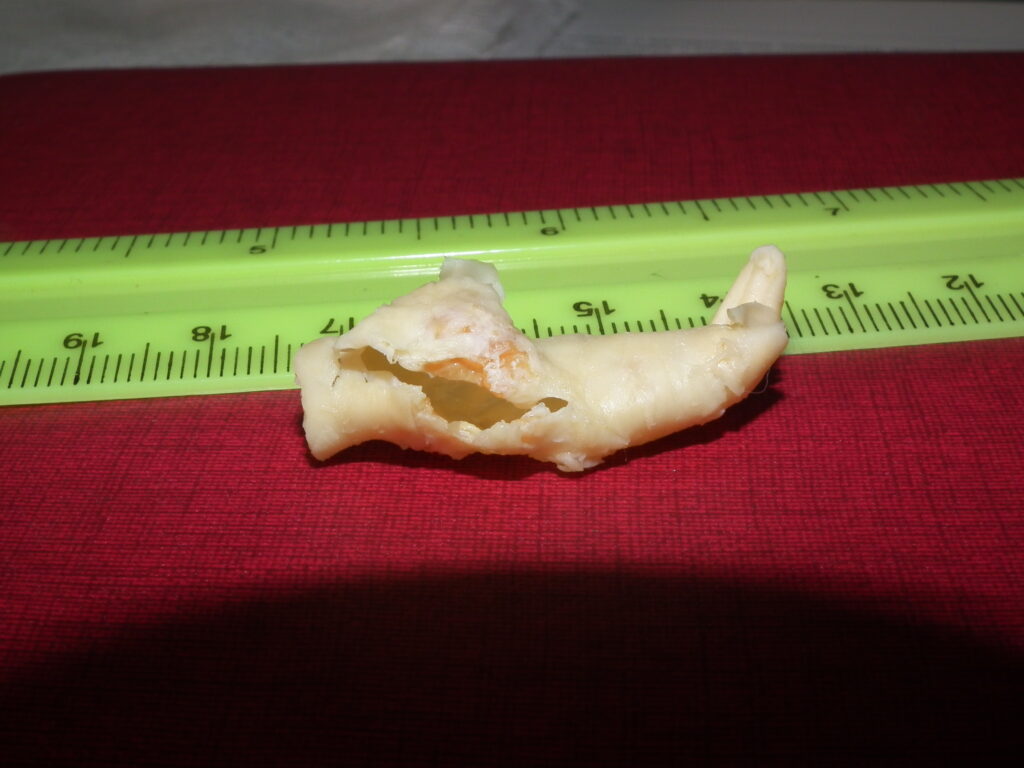 Neurochirurgie carotidiană - placă holesterinică înlaturată din artera carotidă
