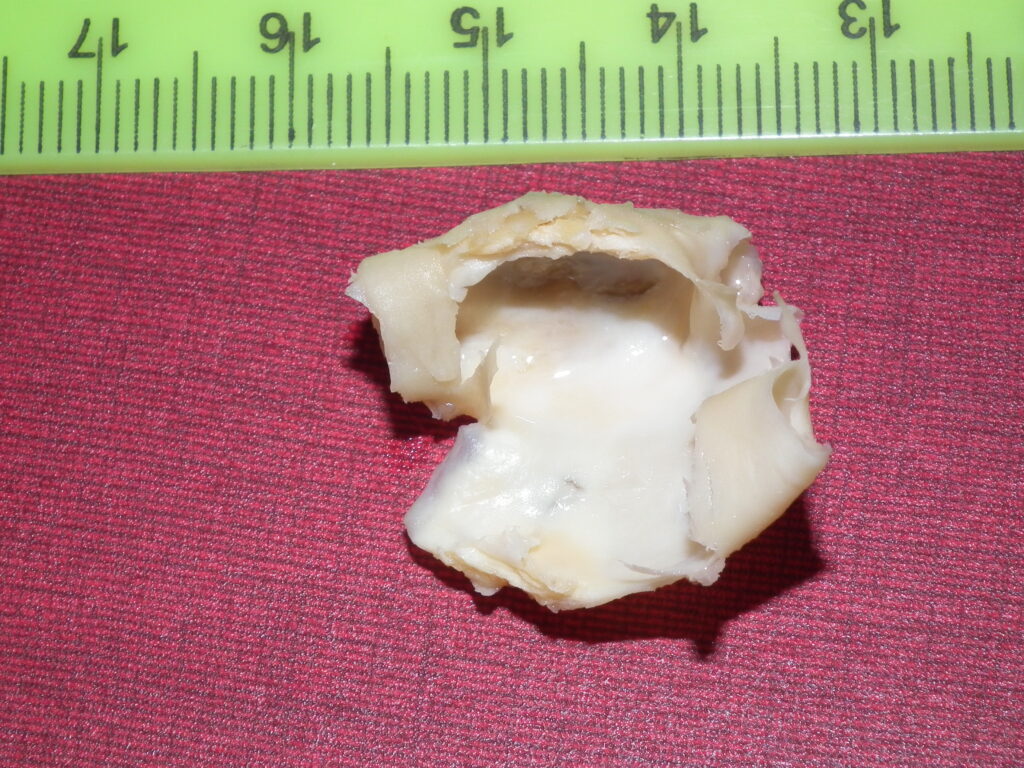 Dr. Adrian Bodiu neurochirurg - fragment placă ateromatoasa, endarterectomie.