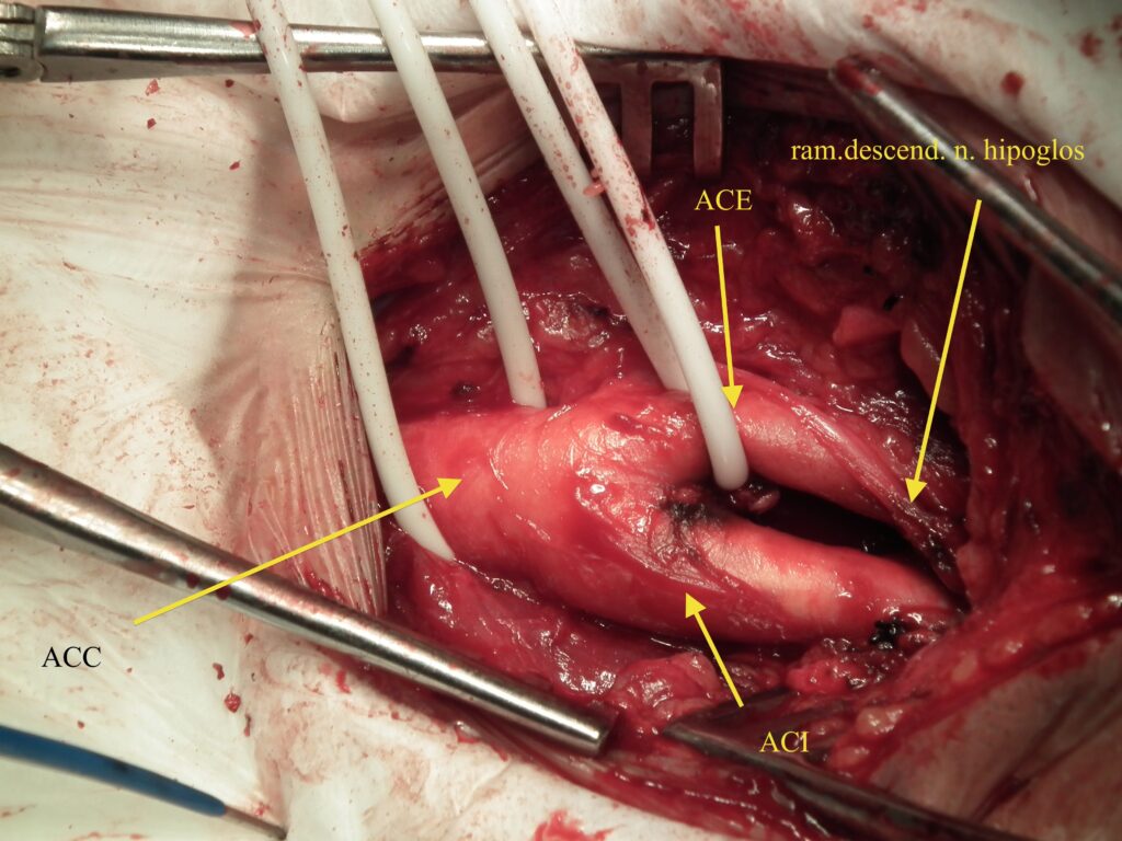 endarterectomie carotidiană- imagine intraoperatorie