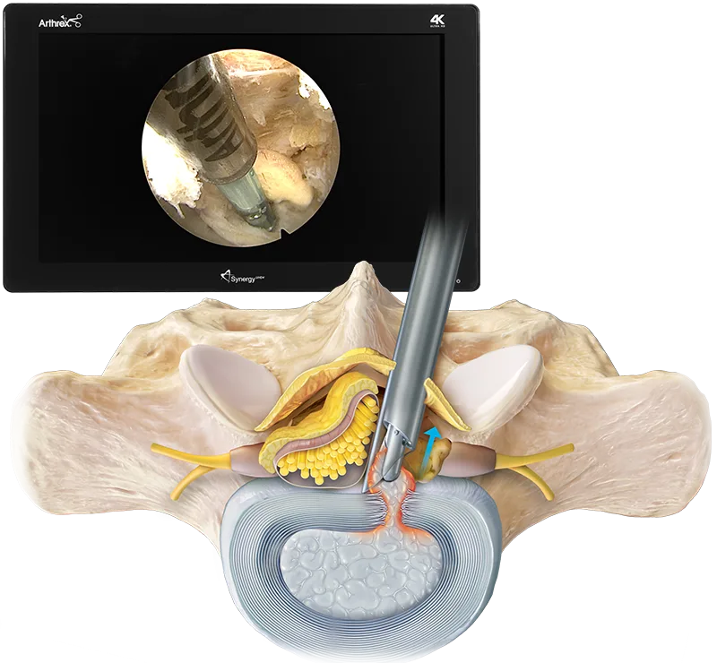 Schema unei discectomii endoscopice lombare cu tub de lucru și instrument endoscopic