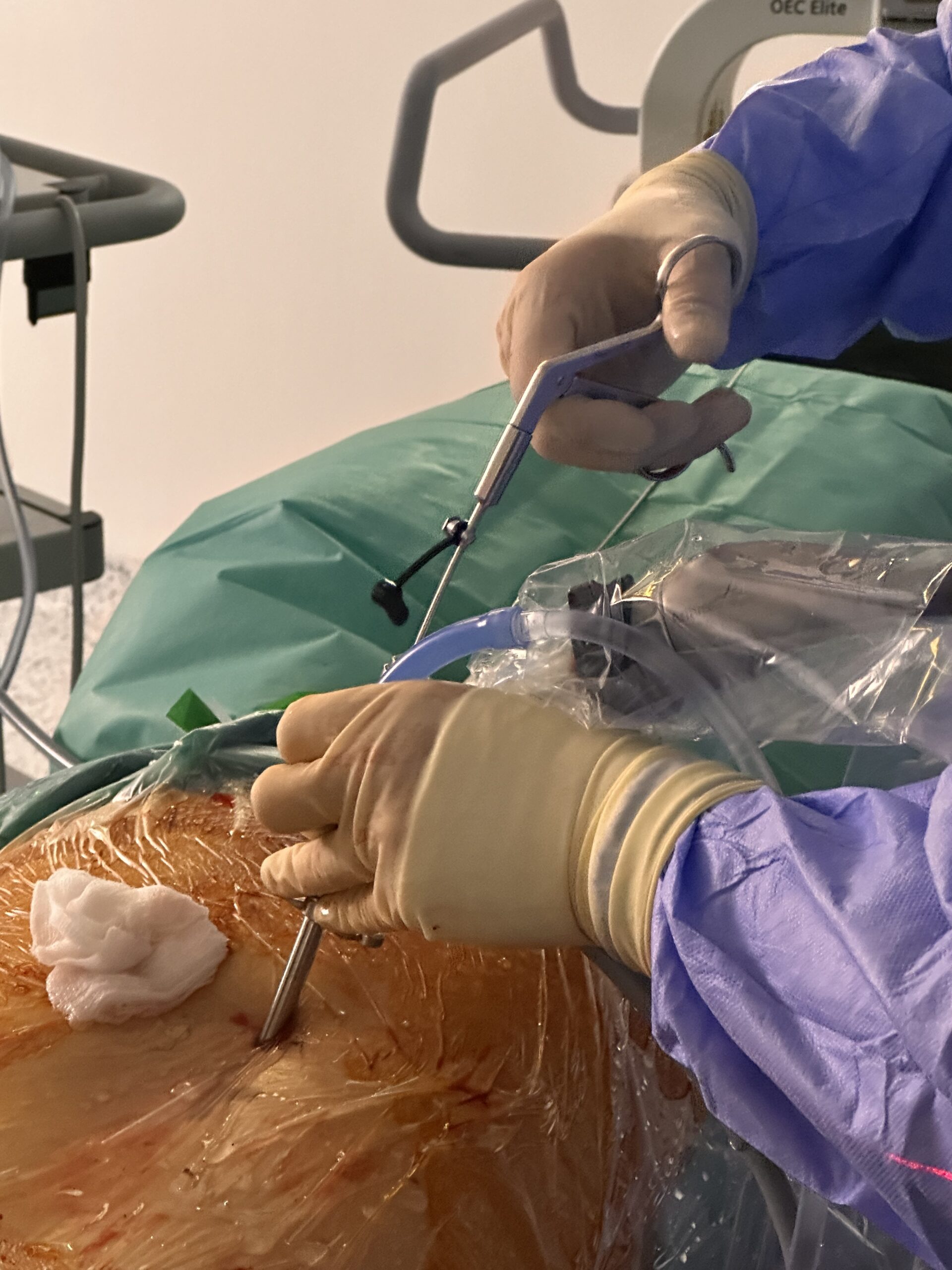 Câmp operator în timpul unei discectomii endoscopice lombare cu tub de lucru
