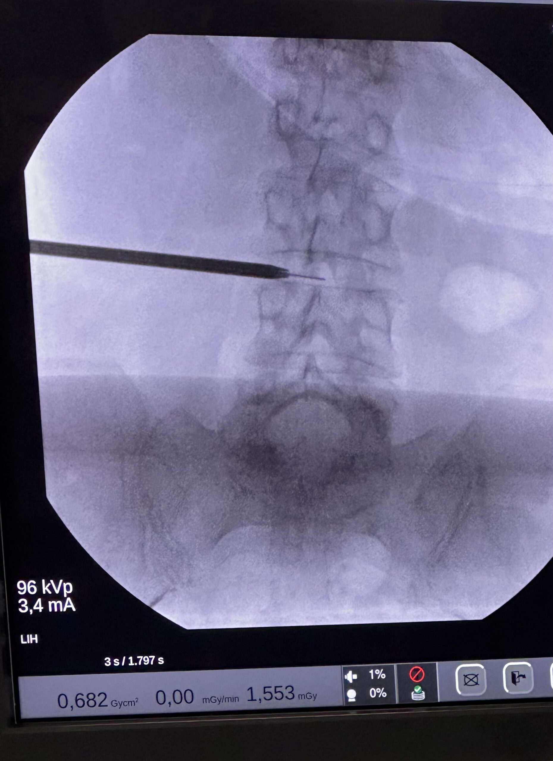 Stabilirea nivelului de abord chirurgical în cadrul unei discectomii endoscopice lombare