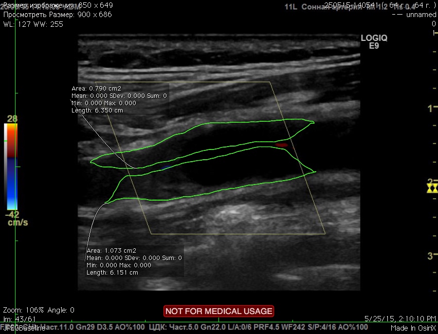 Imagine de ecografie Doppler cu stenoză de arteră carotidă produsă de o placă