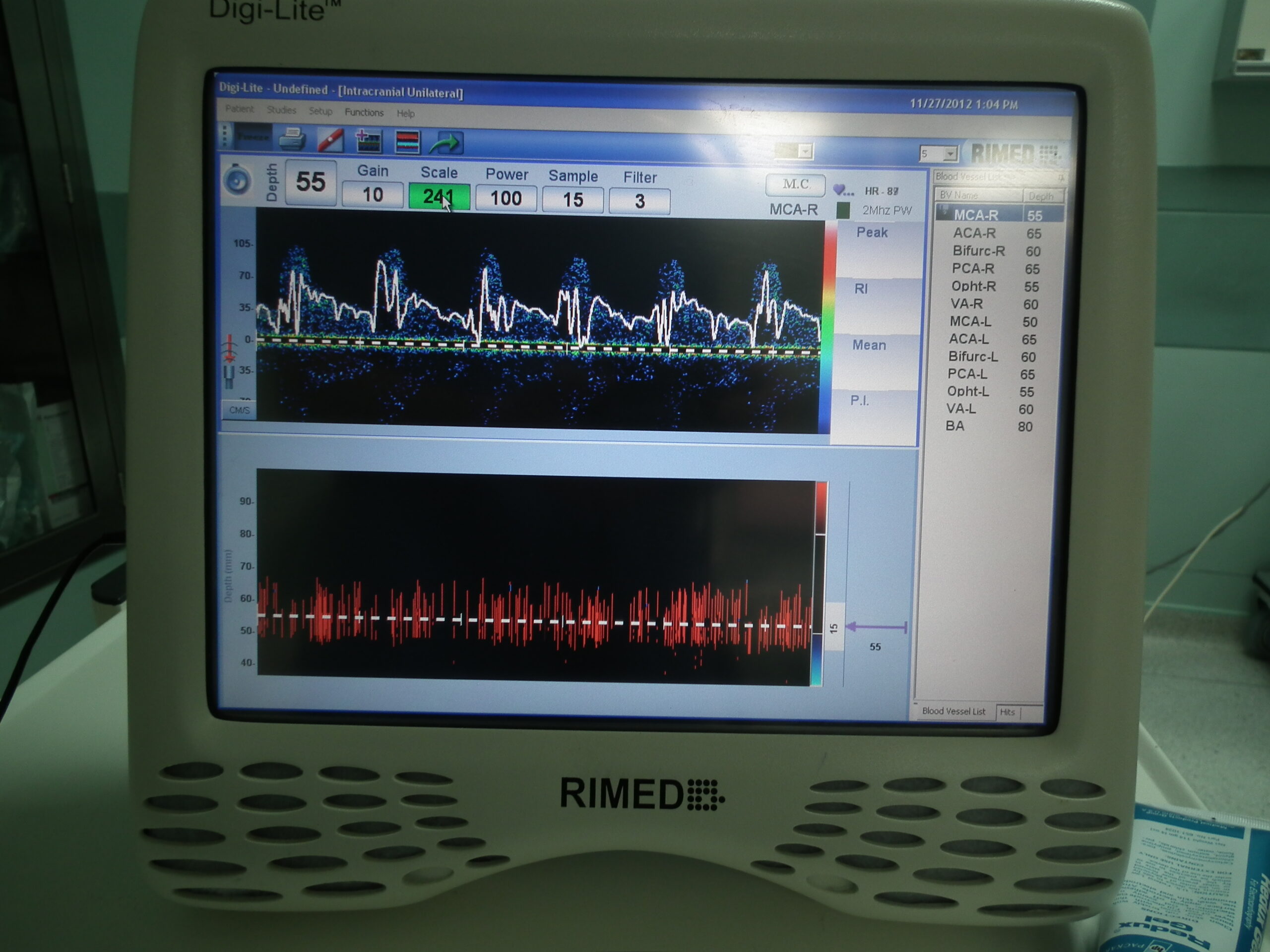Indici velocimetrici ai arterei cerebrale mediane la Doppler transcranian