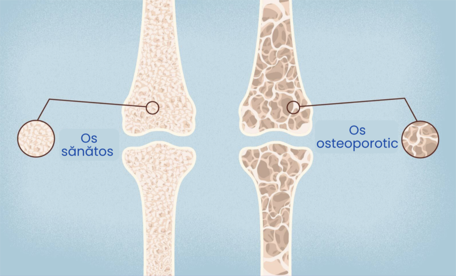 Comparație între os normal și os osteoporotic, evidențiind scăderea densității osoase și structura poroasă
