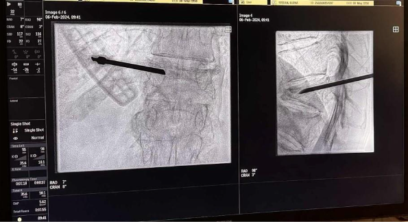 Imagine medicală care ilustrează cifoplastia cu balon înainte de injectarea cimentului osos