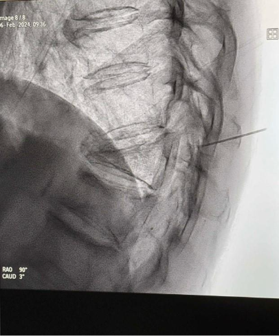 Etapă procedurală pentru tratamentul fracturii vertebrale osteoporotice prin cimentare sub ghidaj imagistic