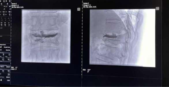 Etapă procedurală în cifoplastie, cu pregătirea cavității înainte de injectarea cimentului osos