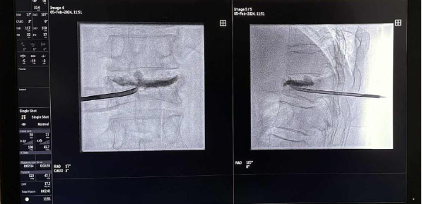 Acces în corpul vertebral pentru vertebroplastie sau cifoplastie sub ghidaj imagistic