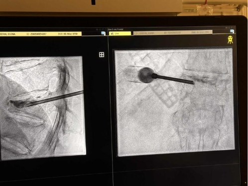 Injectare controlată a cimentului osos în corpul vertebral în procedura de vertebroplastie