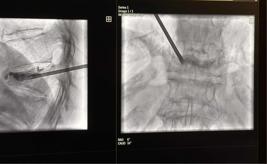 Aspect post-procedural după stabilizarea vertebrei cu ciment osos în fracturi vertebrale osteoporotice
