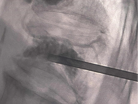 Imagine rezumativă a etapelor procedurilor de vertebroplastie și cifoplastie pentru fracturi vertebrale osteoporotice