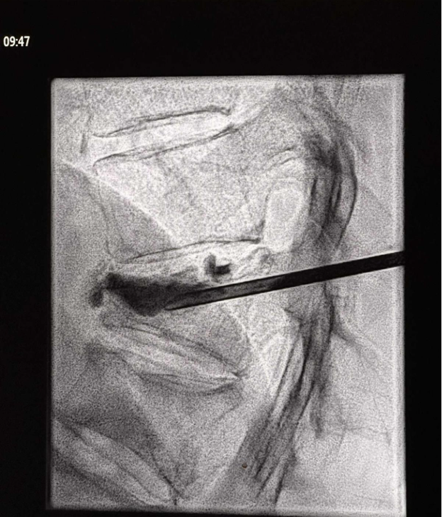 vertebroplastie și chifoplastie pentru durere prin tasare vertebrală osteoporotică
