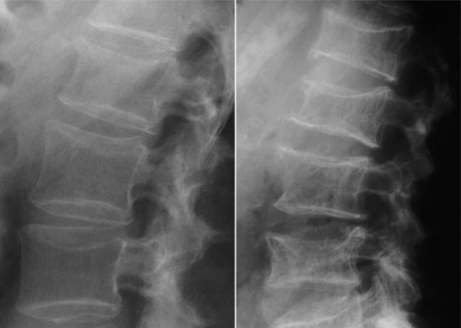 Ilustrație medicală a coloanei vertebrale lombare evidențiind tasare vertebrală osteoporotică