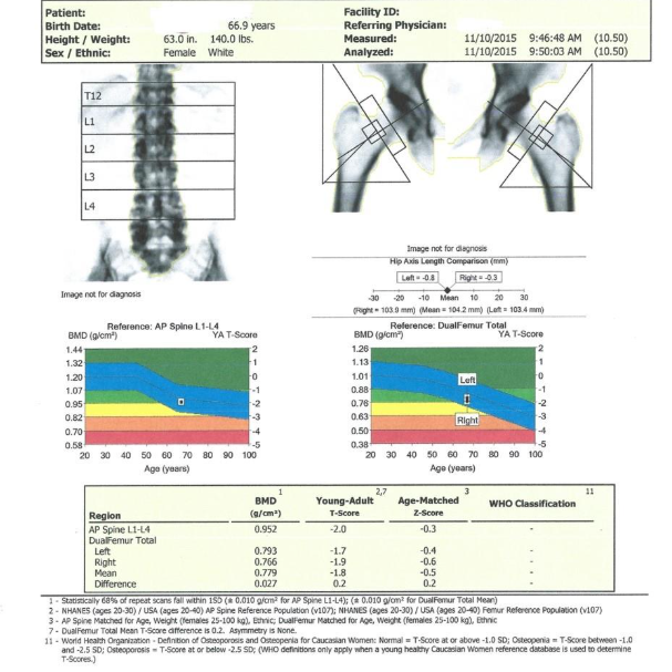 Radiografie laterală a coloanei vertebrale care evidențiază vertebre tasate prin fracturi de compresie, sugestiv pentru osteoporoză