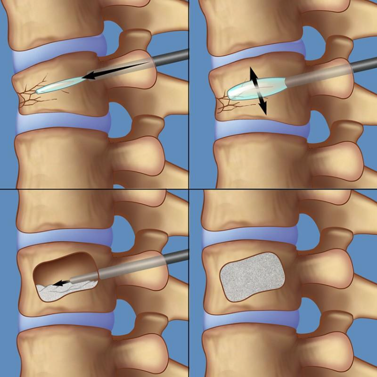 Ilustrație medicală care compară vertebroplastia și cifoplastia pentru tratamentul fracturilor vertebrale osteoporotice