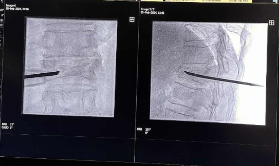Ilustrație medicală a vertebroplastiei cu injectare de ciment osos în vertebra fracturată