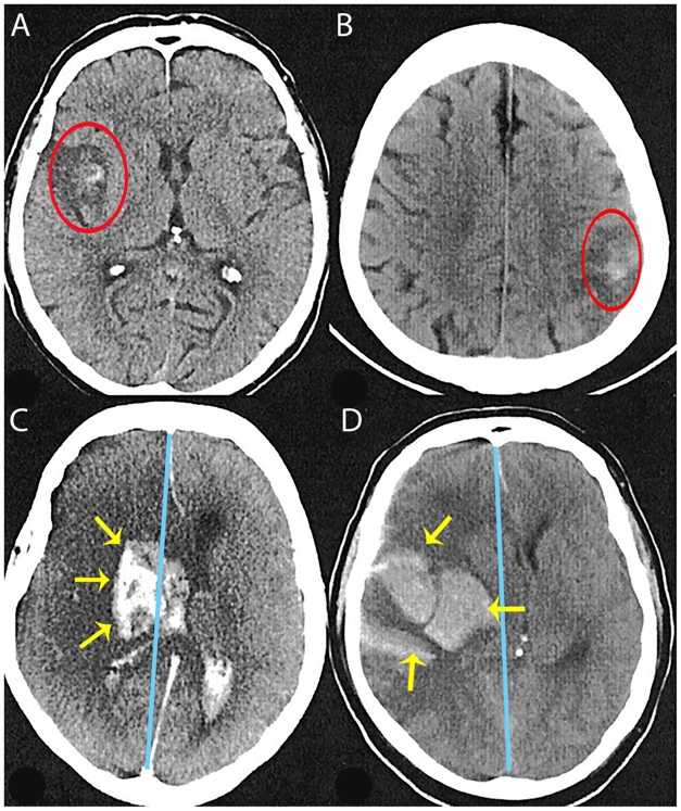 Accident vascular cerebral hemoragic pe CT cerebral cu sângerare intraparenchimatoasă