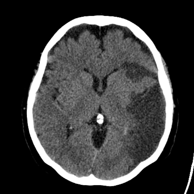 Accident vascular cerebral ischemic pe CT cerebral fără contrast