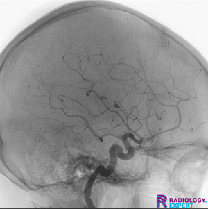 DSA angiografie cerebrală în accident vascular cerebral cu ocluzie arterială