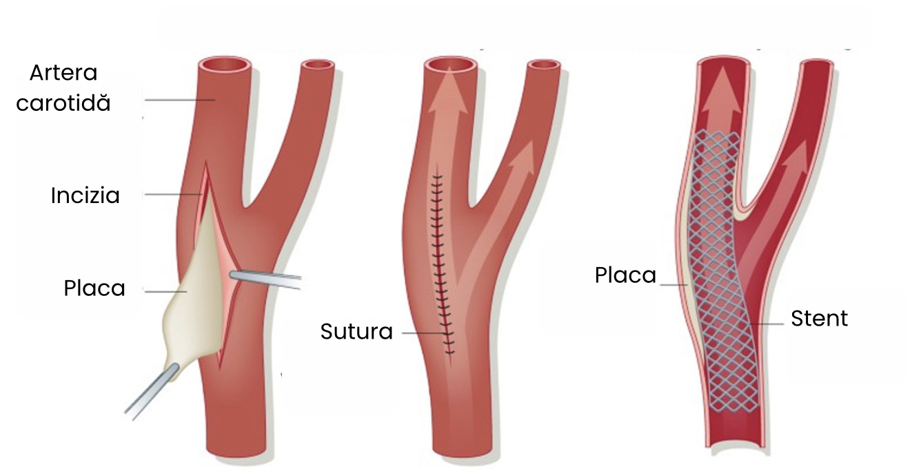Comparație între endarterectomie carotidiană și stentare carotidiană
