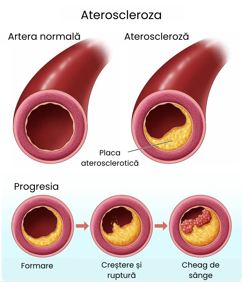 Ateroscleroza carotidiană: placă de aterom și stenoză a arterei carotide