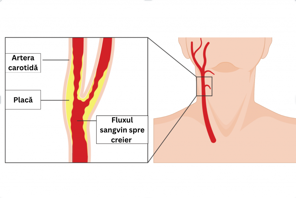 Stenoză carotidiană produsă de placă aterosclerotică și scăderea fluxului către creier