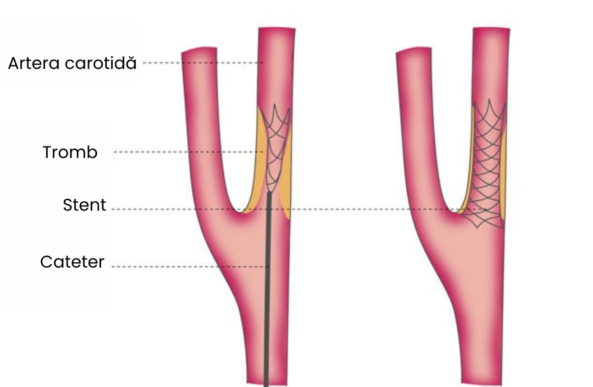 Endarterectomie carotidiană (EC/CEA) – opțiune chirurgicală pentru tratamentul stenozei