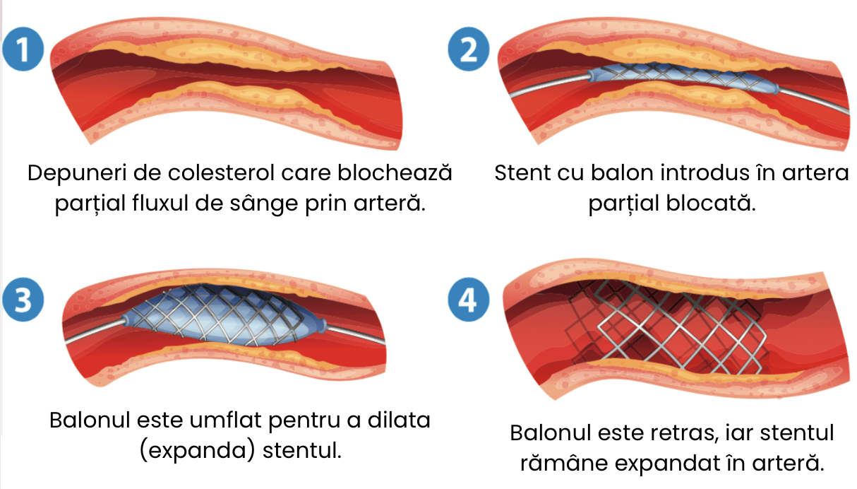 Stent carotidian (CAS): protecție embolică și implantarea stentului în artera carotidă