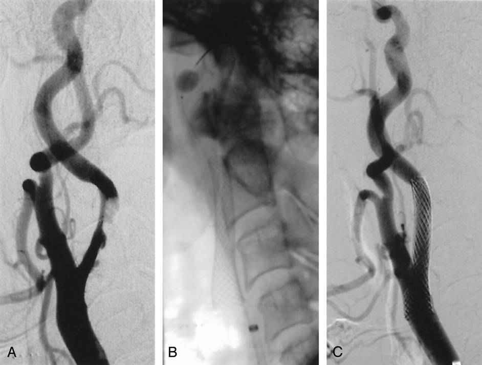 Stentare carotidiană: imagini angiografice pre și post procedură (DSA)