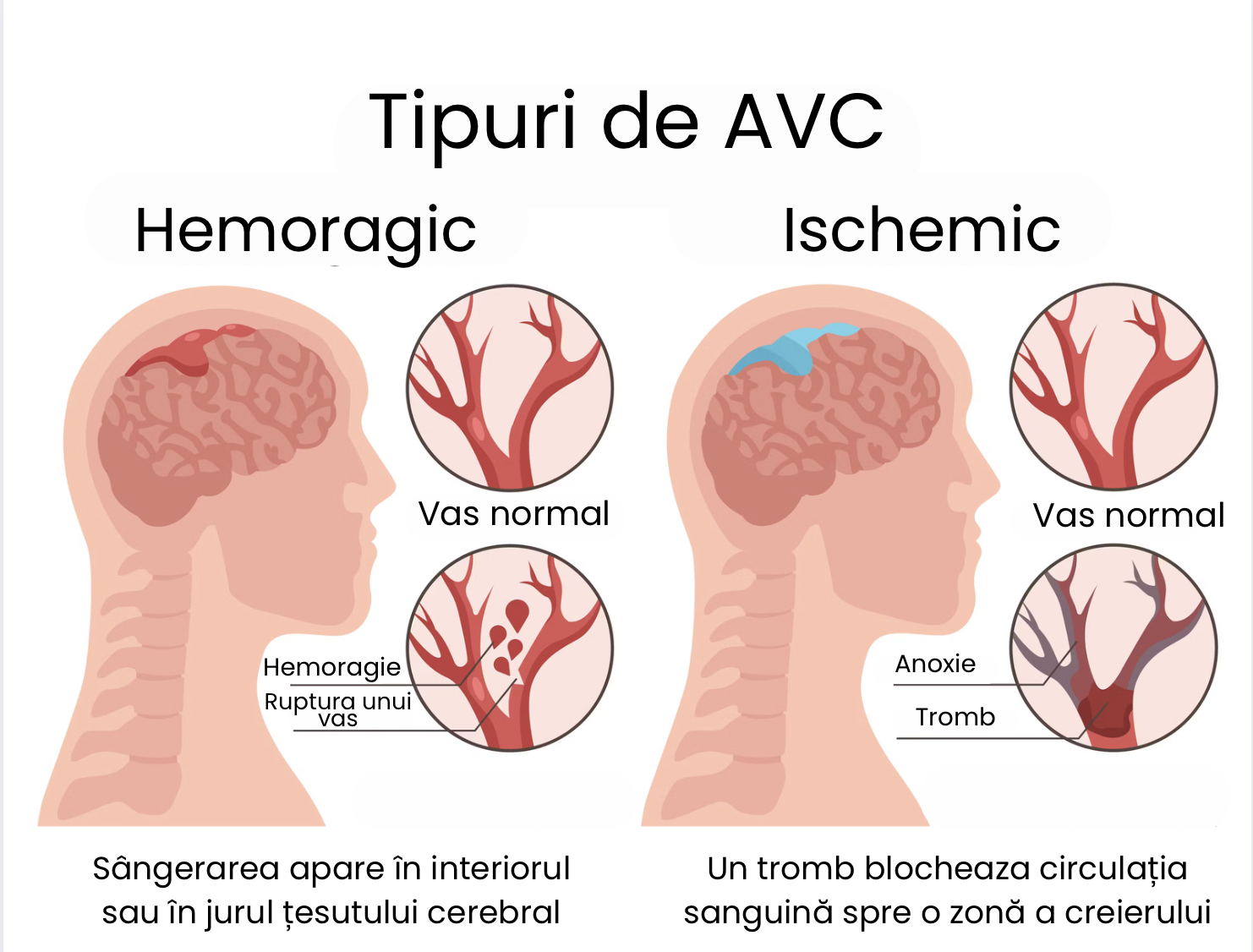 Tipuri de accident vascular cerebral: ischemic, hemoragic și TIA