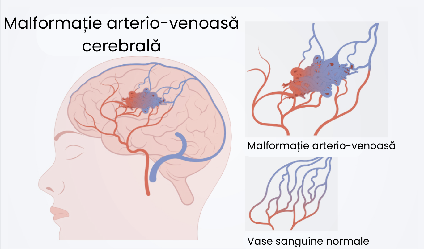 Malformatiile arterio-venoase cerebrale (MAV) – schema conexiune arterio-venoasa
