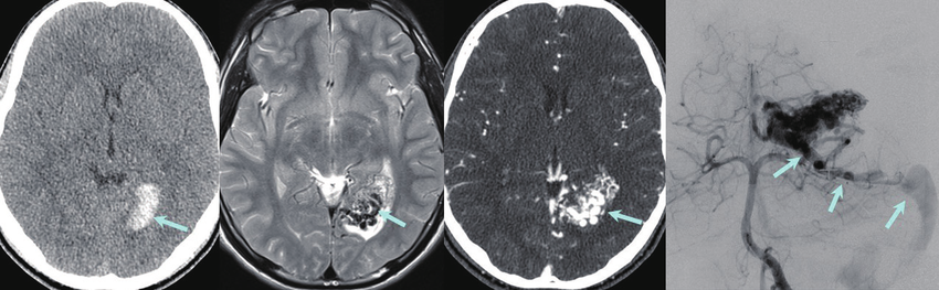 Malformatiile arterio-venoase cerebrale – investigatii CT/RMN si angiografie