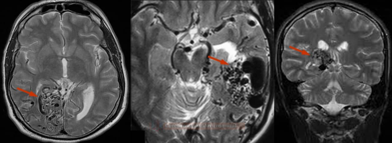 Malformatiile arterio-venoase cerebrale – exemplu imagistic RMN