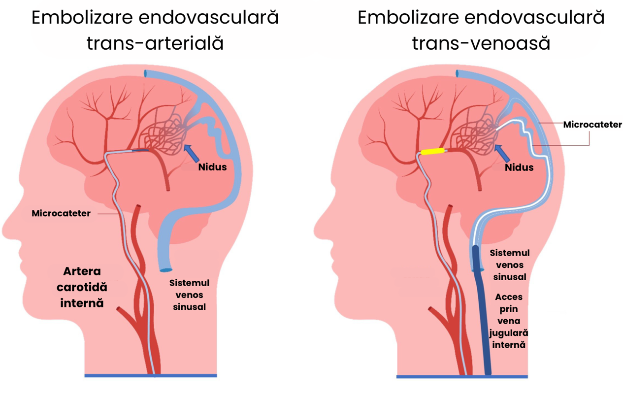 Malformatiile arterio-venoase cerebrale – embolizare endovasculara