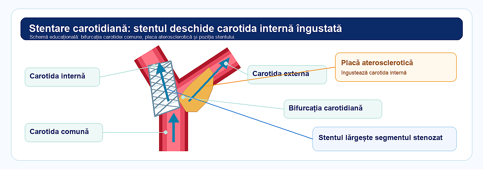 stentare carotidianÄ la bifurcaÈia carotidei comune Èi carotidei interne